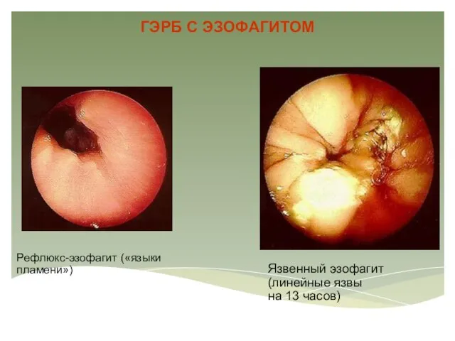 ГЭРБ С ЭЗОФАГИТОМ Рефлюкс-эзофагит («языки пламени») Язвенный эзофагит (линейные язвы на 13 часов)