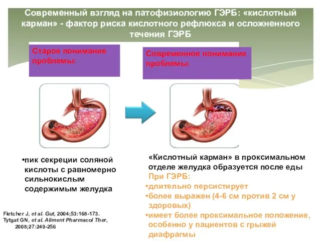 Современный взгляд на патофизиологию ГЭРБ: «кислотный карман» - фактор риска кислотного