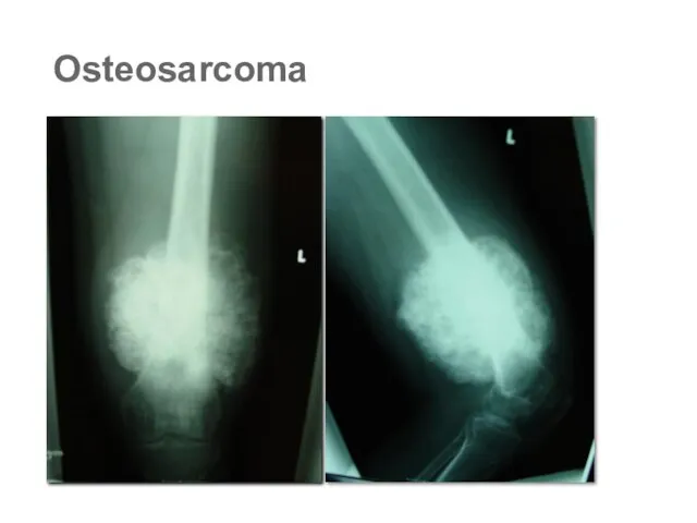 Osteosarcoma