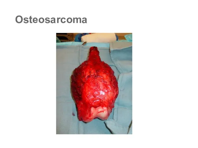 Osteosarcoma