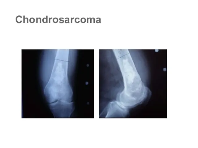 Chondrosarcoma