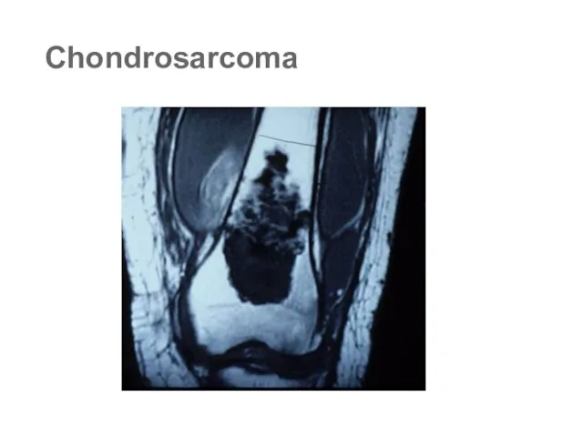 Chondrosarcoma