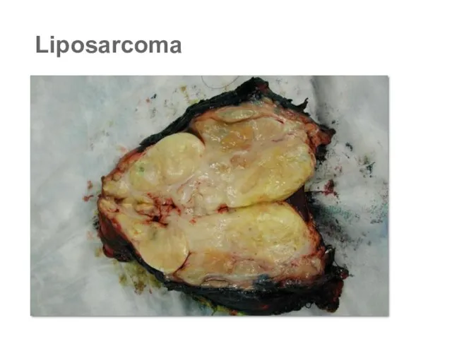 Liposarcoma