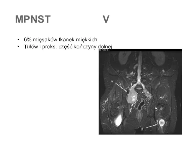 MPNST V 6% mięsaków tkanek miękkich Tułów i proks. część kończyny dolnej