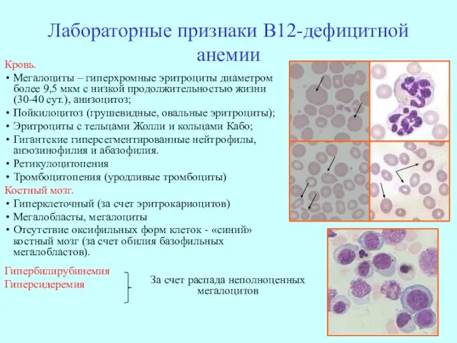 Лабораторные признаки В12-дефицитной анемии Кровь. Мегалоциты – гиперхромные эритроциты диаметром более