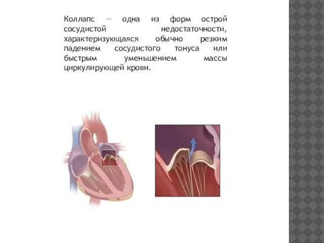 Коллапс — одна из форм острой сосудистой недостаточности, характеризующаяся обычно резким