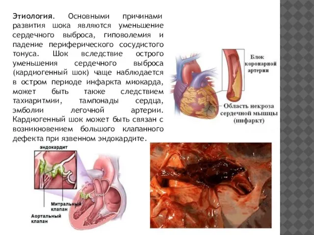 Этиология. Основными причинами развития шока являются уменьшение сердечного выброса, гиповолемия и