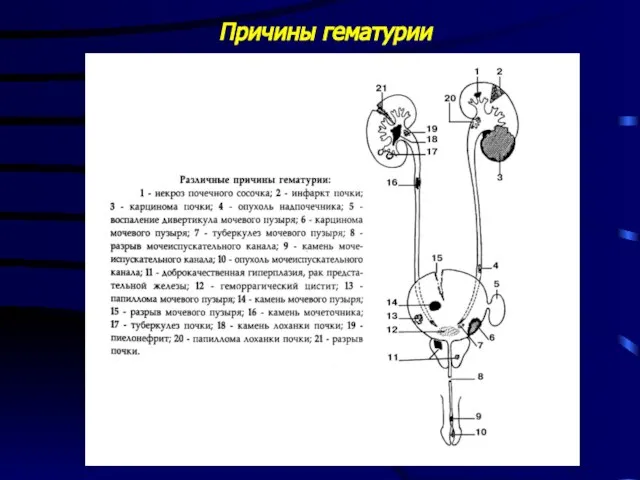 Причины гематурии