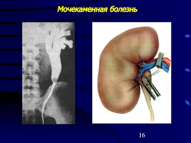 Мочекаменная болезнь