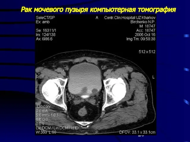 Рак мочевого пузыря компьютерная томография