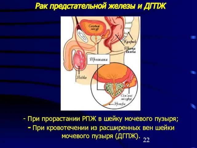 Рак предстательной железы и ДГПЖ - При прорастании РПЖ в шейку