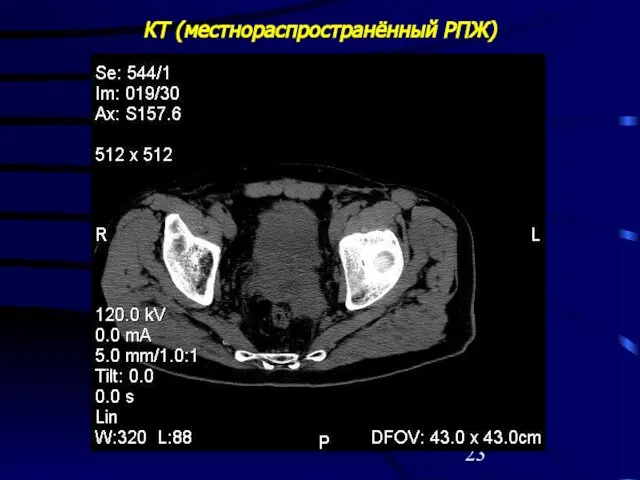 КТ (местнораспространённый РПЖ)