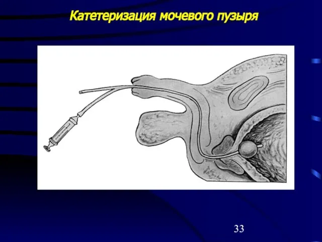 Катетеризация мочевого пузыря