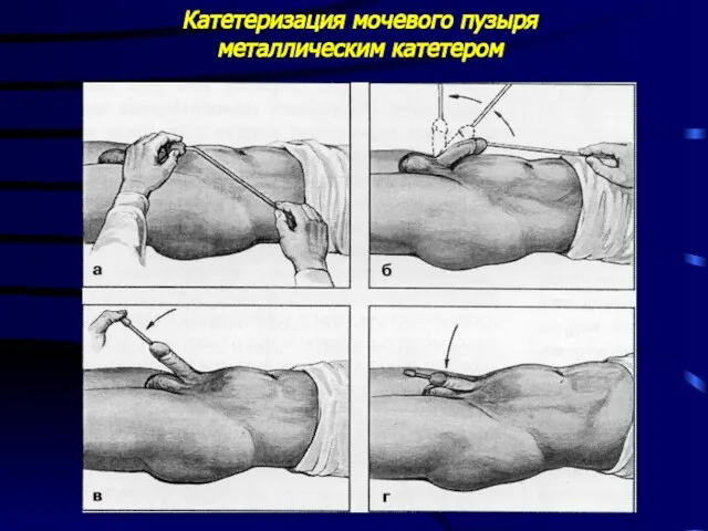 Катетеризация мочевого пузыря металлическим катетером