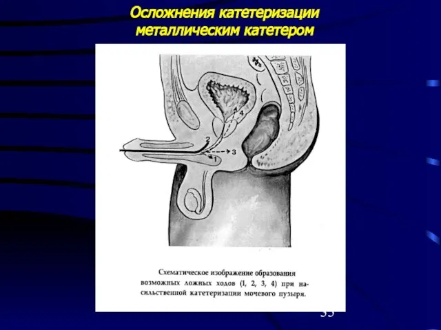 Осложнения катетеризации металлическим катетером