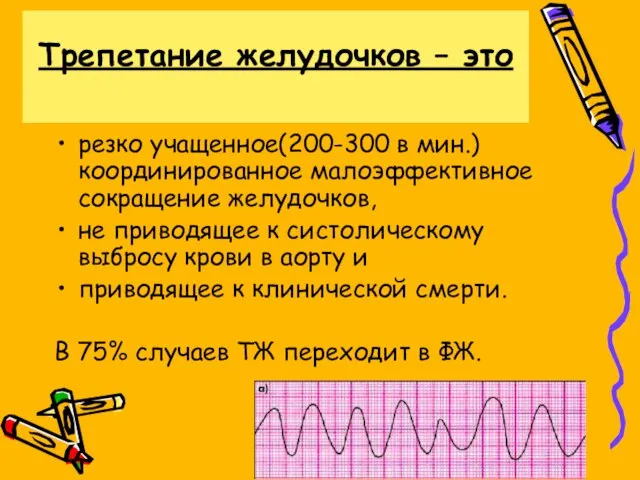 Трепетание желудочков – это резко учащенное(200-300 в мин.) координированное малоэффективное сокращение