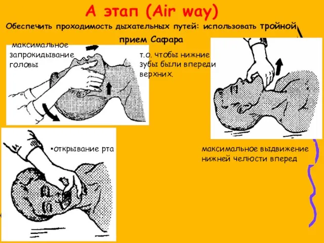 A этап (Air way) Обеспечить проходимость дыхательных путей: использовать тройной прием