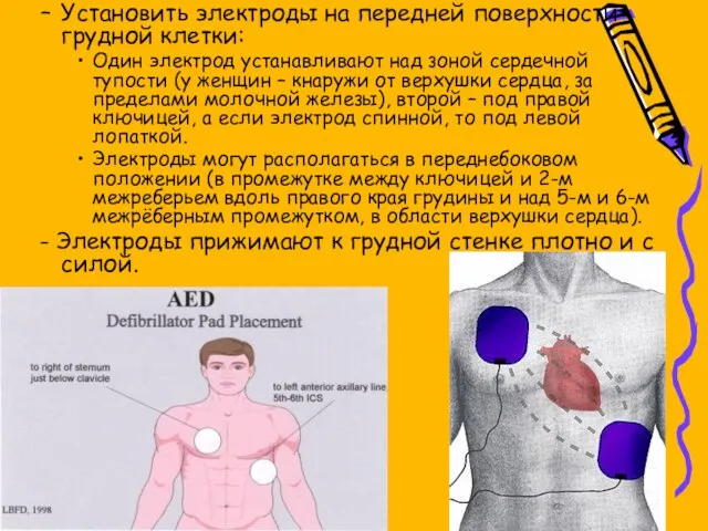 Установить электроды на передней поверхности грудной клетки: Один электрод устанавливают над