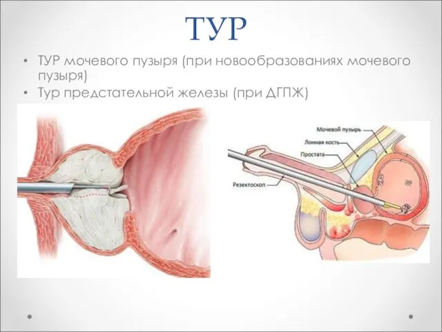 ТУР ТУР мочевого пузыря (при новообразованиях мочевого пузыря) Тур предстательной железы (при ДГПЖ)