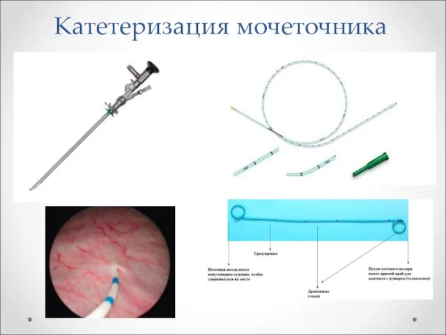 Катетеризация мочеточника