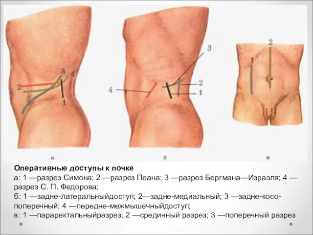 Оперативные доступы к почке а: 1 —разрез Симона; 2 —разрез Пеана;