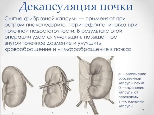 Декапсуляция почки Снятие фиброзной капсулы — применяют при остром пиелонефрите, перинефрите,