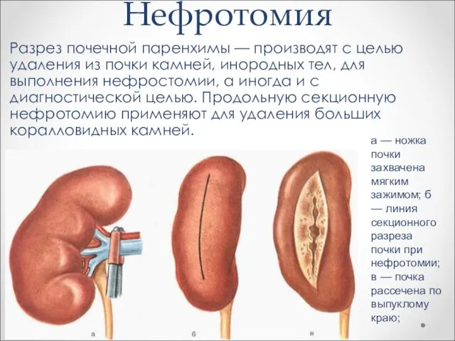 Нефротомия Разрез почечной паренхимы — производят с целью удаления из почки