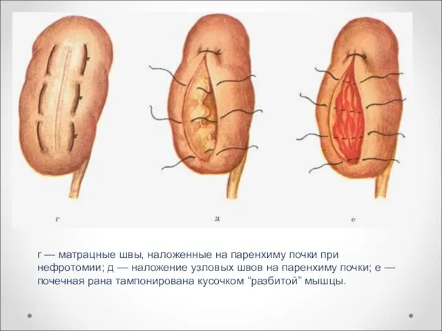 г — матрацные швы, наложенные на паренхиму почки при нефротомии; д