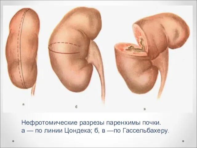 Нефротомические разрезы паренхимы почки. а — по линии Цондека; б, в —по Гассельбахеру.