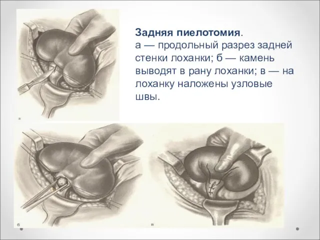 Задняя пиелотомия. а — продольный разрез задней стенки лоханки; б —