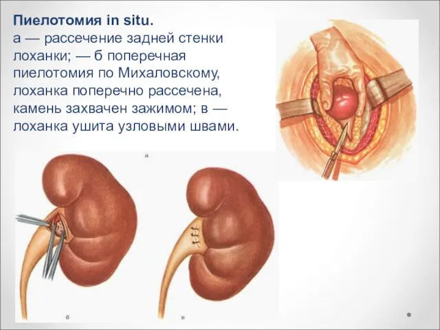 Пиелотомия in situ. a — рассечение задней стенки лоханки; — б