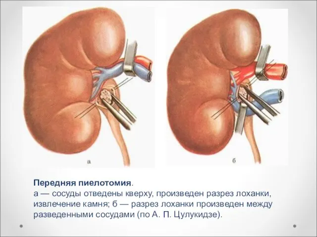 Передняя пиелотомия. а — сосуды отведены кверху, произведен разрез лоханки, извлечение