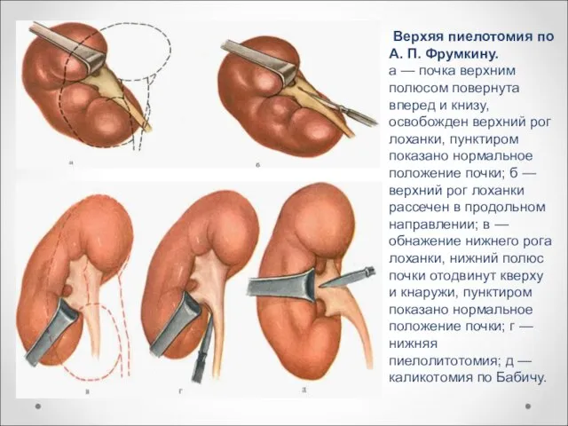 Верхяя пиелотомия по А. П. Фрумкину. а — почка верхним полюсом