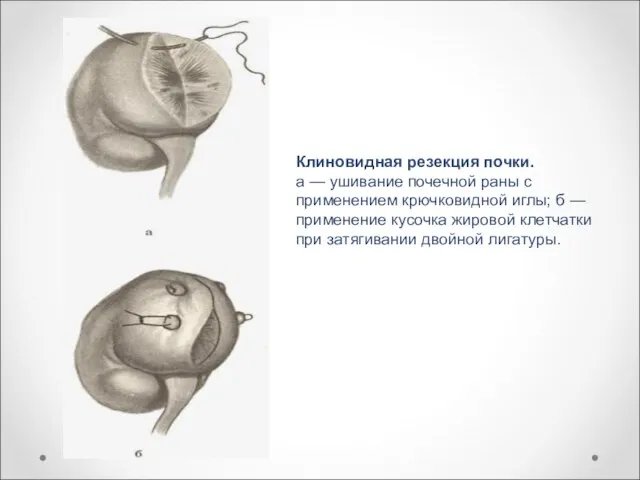 Клиновидная резекция почки. а — ушивание почечной раны с применением крючковидной