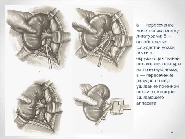 а — пересечение мочеточника между лигатурами; б — освобождение сосудистой ножки