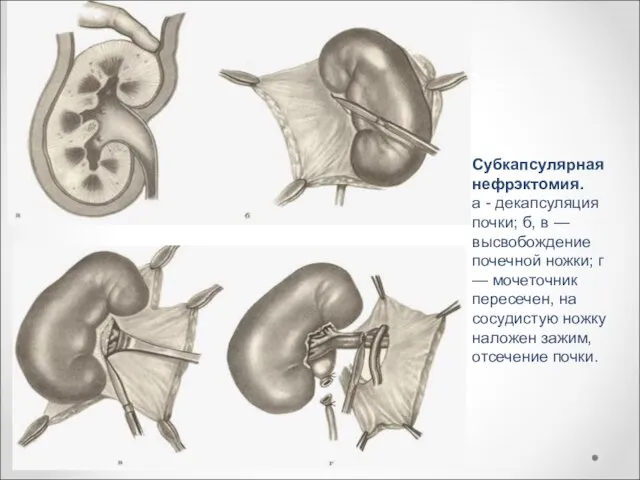 Субкапсулярная нефрэктомия. а - декапсуляция почки; б, в — высвобождение почечной