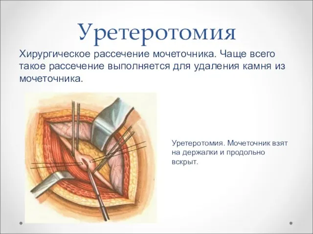 Уретеротомия Хирургическое рассечение мочеточника. Чаще всего такое рассечение выполняется для удаления