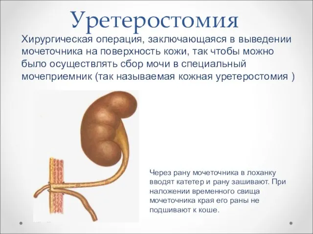 Уретеростомия Хирургическая операция, заключающаяся в выведении мочеточника на поверхность кожи, так