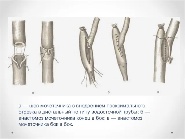 а — шов мочеточника с внедрением проксимального отрезка в дистальный по