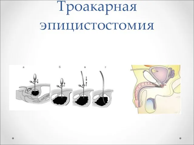 Троакарная эпицистостомия