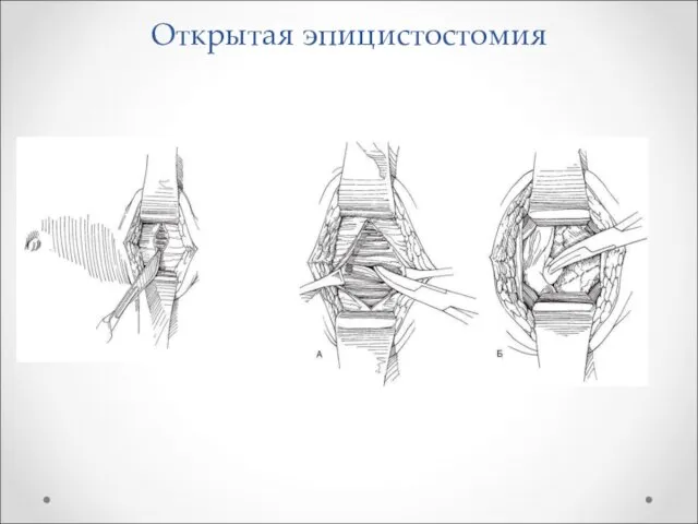 Открытая эпицистостомия