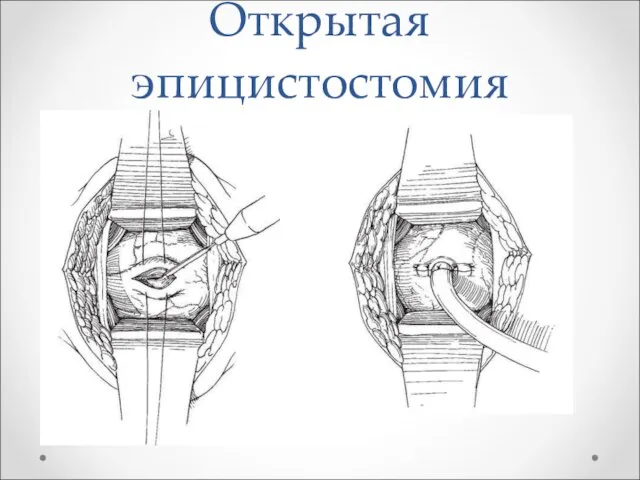 Открытая эпицистостомия