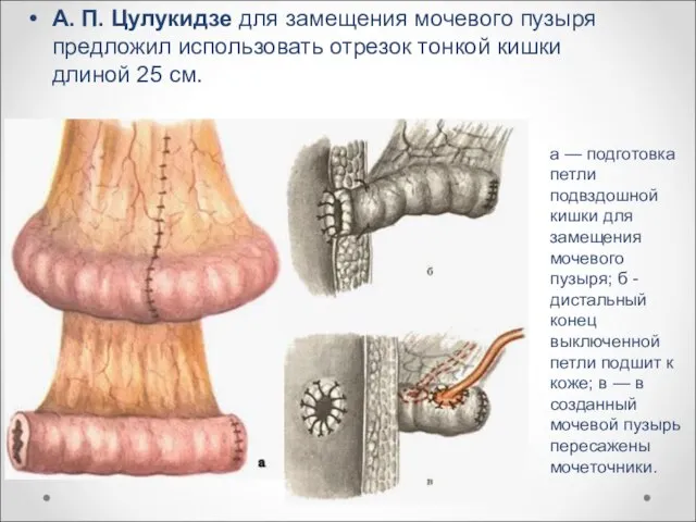 А. П. Цулукидзе для замещения мочевого пузыря предложил использовать отрезок тонкой
