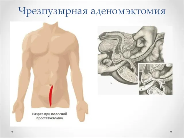 Чрезпузырная аденомэктомия