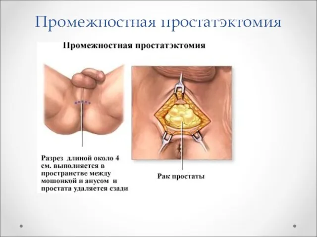 Промежностная простатэктомия