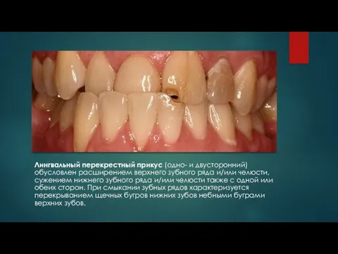 . Лингвальный перекрестный прикус (одно- и двусторонний) обусловлен расширением верхнего зубного