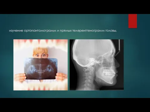 изучение ортопантомограмм и прямых телерентгенограмм головы.