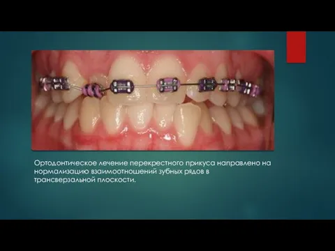 . Ортодонтическое лечение перекрестного прикуса направлено на нормализацию взаимоотношений зубных рядов в трансверзальной плоскости.