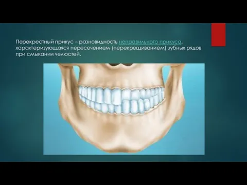Перекрестный прикус – разновидность неправильного прикуса, характеризующаяся пересечением (перекрещиванием) зубных рядов при смыкании челюстей.