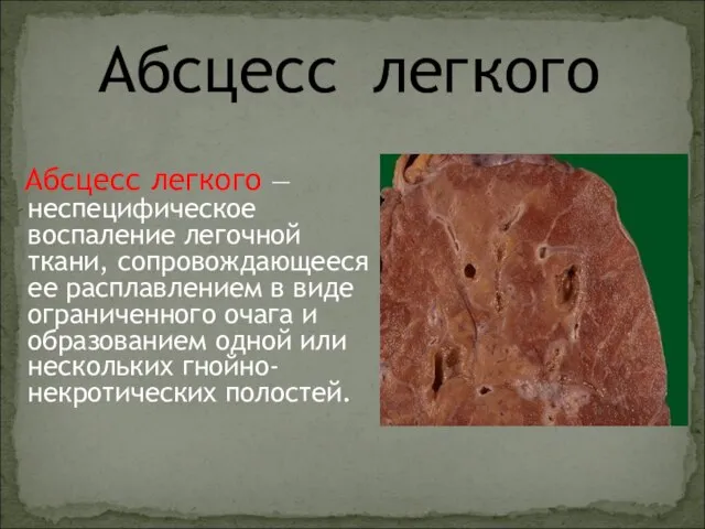 Абсцесс легкого Абсцесс легкого — неспецифическое воспаление легочной ткани, сопровождающееся ее